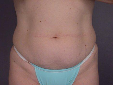 Liposuction Before & After Image