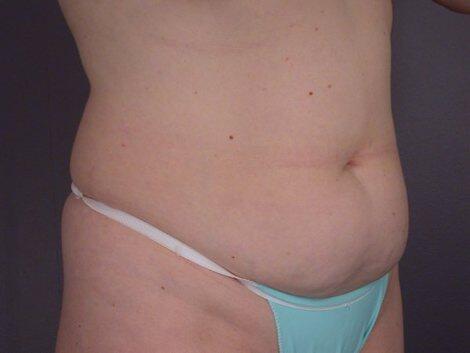 Liposuction Before & After Image