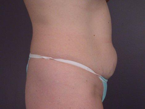 Liposuction Before & After Image