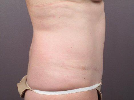 Liposuction Before & After Image