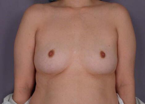 Liposuction Before & After Image