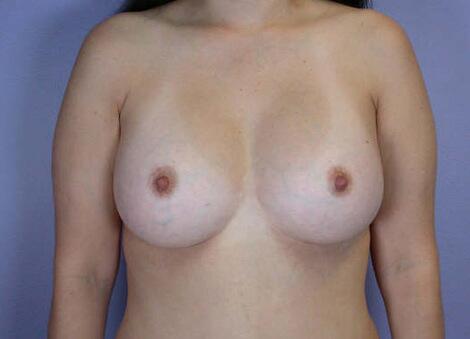 Liposuction Before & After Image