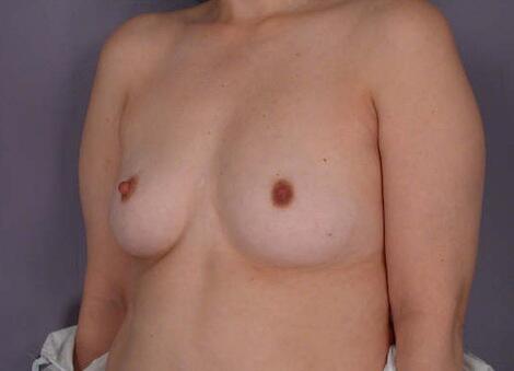 Liposuction Before & After Image