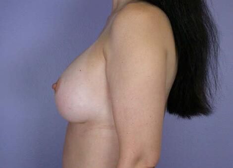 Liposuction Before & After Image