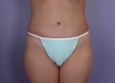 Liposuction Before & After Image