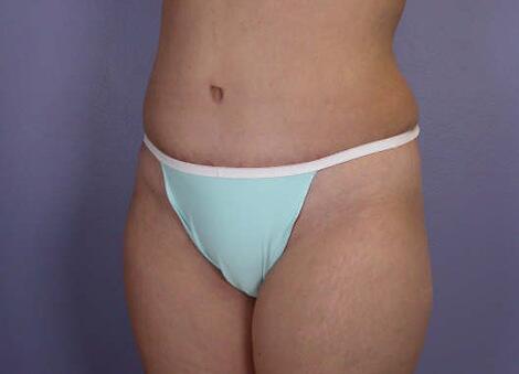 Liposuction Before & After Image