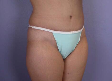 Liposuction Before & After Image