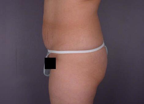 Liposuction Before & After Image