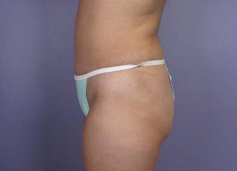 Liposuction Before & After Image