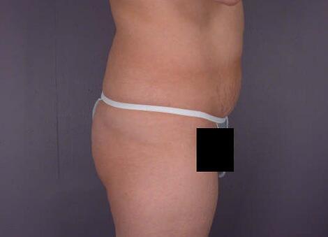 Liposuction Before & After Image