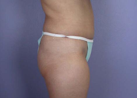 Liposuction Before & After Image