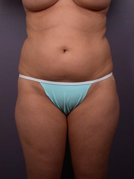 Liposuction Before & After Image