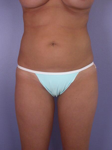 Liposuction Before & After Image