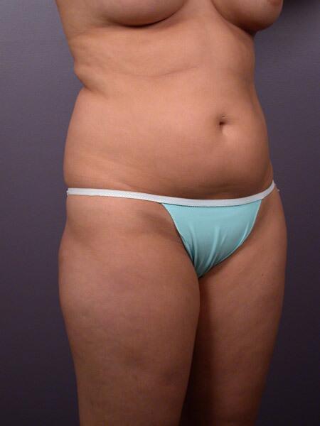 Liposuction Before & After Image