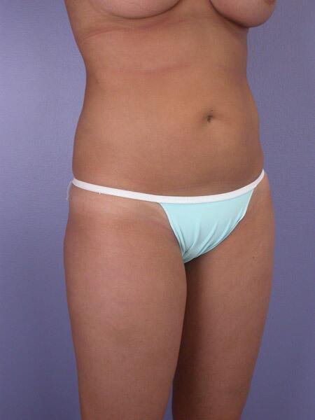 Liposuction Before & After Image