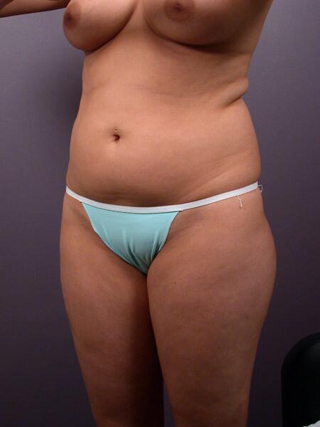 Liposuction Before & After Image