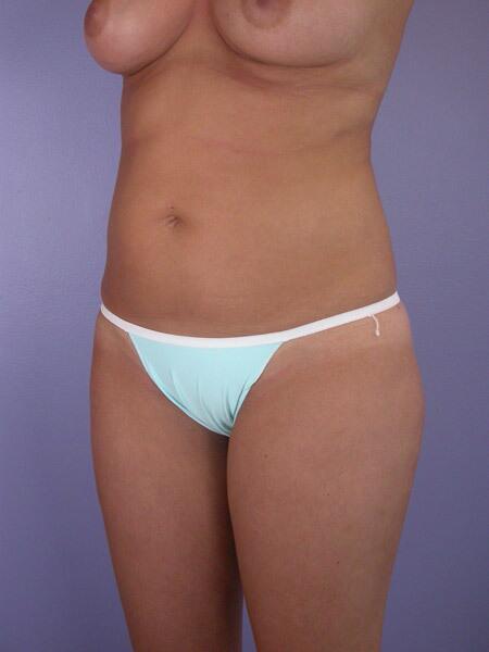 Liposuction Before & After Image