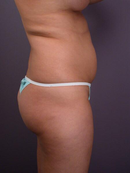 Liposuction Before & After Image