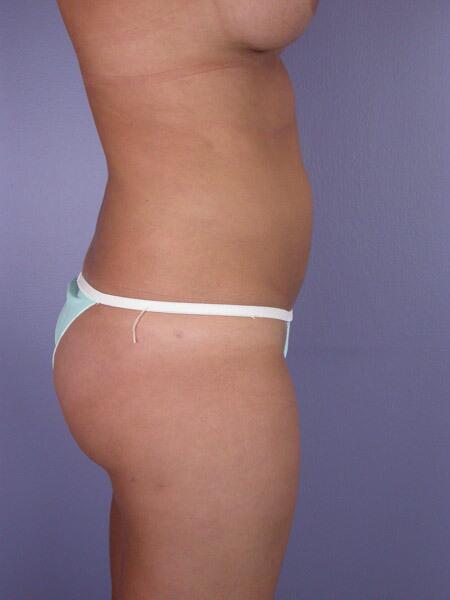 Liposuction Before & After Image