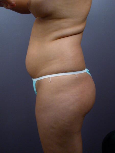 Liposuction Before & After Image