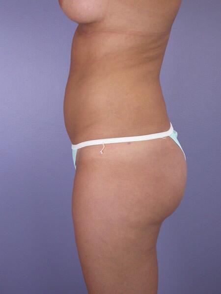 Liposuction Before & After Image