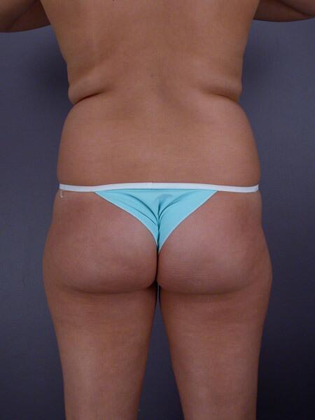 Liposuction Before & After Image