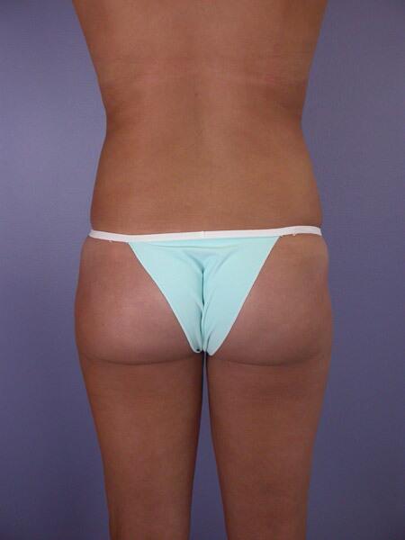 Liposuction Before & After Image