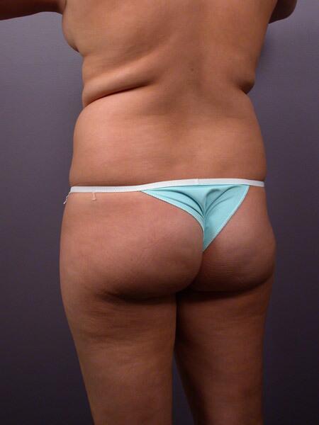 Liposuction Before & After Image