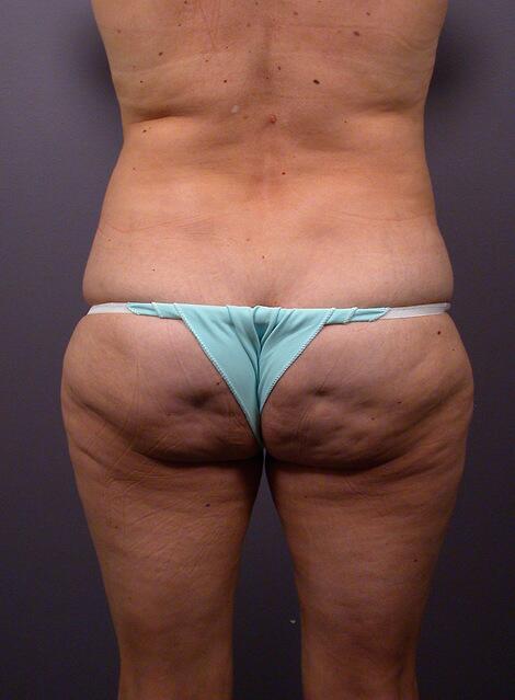 Liposuction Before & After Image