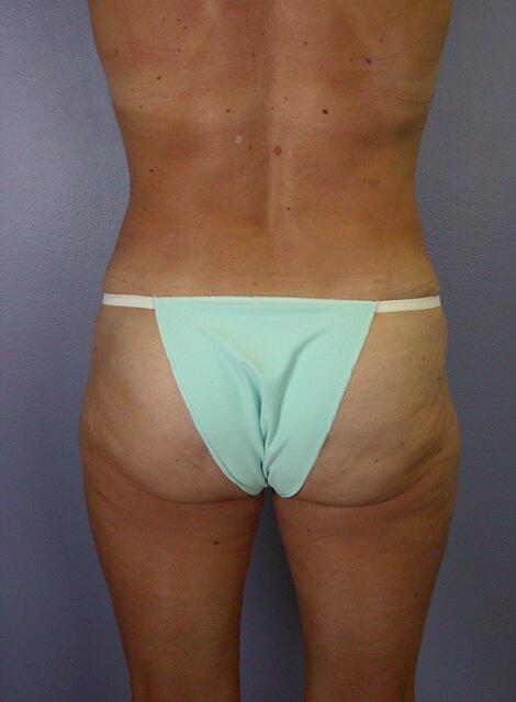 Liposuction Before & After Image