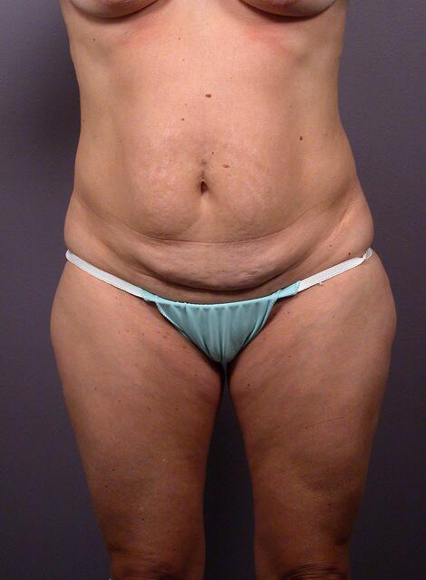 Liposuction Before & After Image