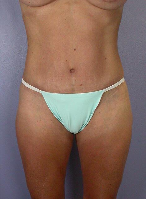 Liposuction Before & After Image