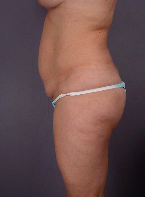 Liposuction Before & After Image