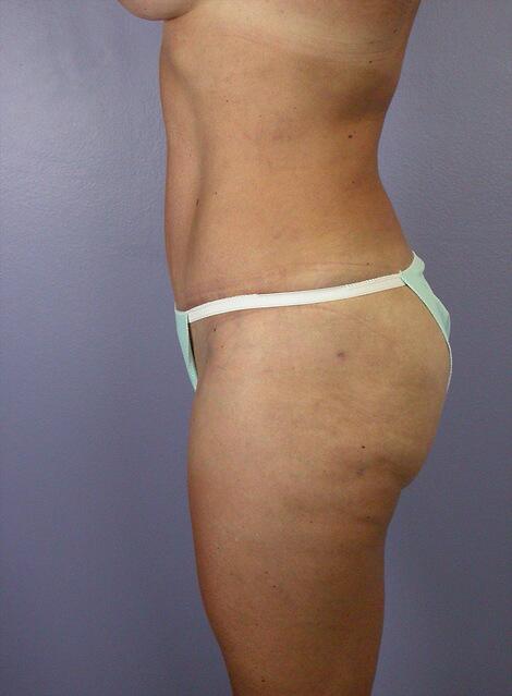 Liposuction Before & After Image