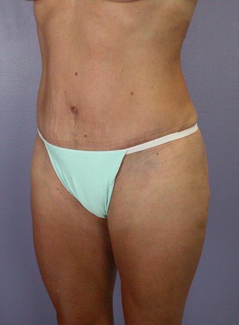 Liposuction Before & After Image