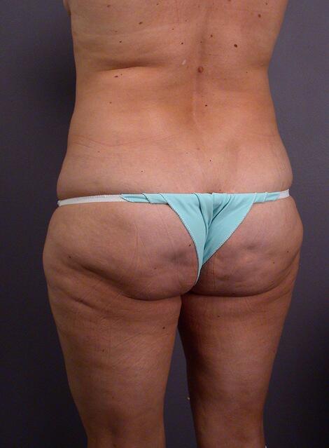 Liposuction Before & After Image