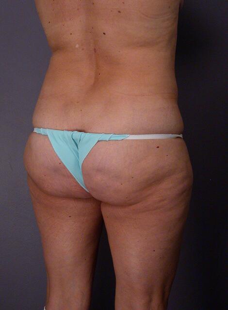 Liposuction Before & After Image