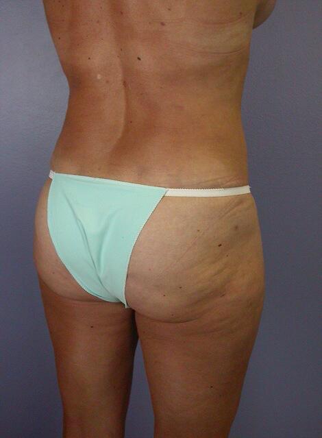 Liposuction Before & After Image