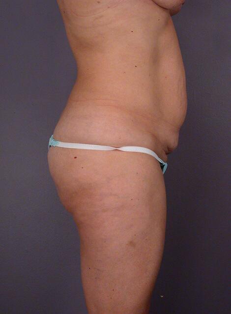 Liposuction Before & After Image