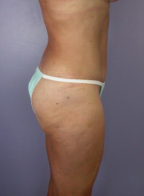 Liposuction Before & After Image