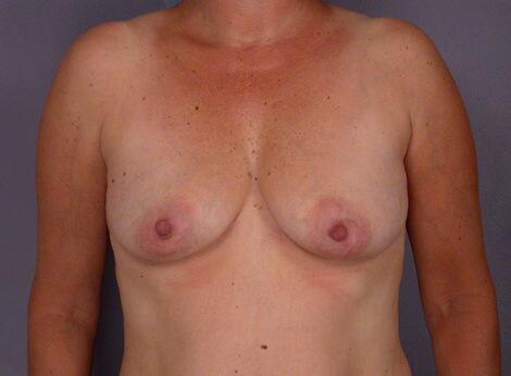 Liposuction Before & After Image