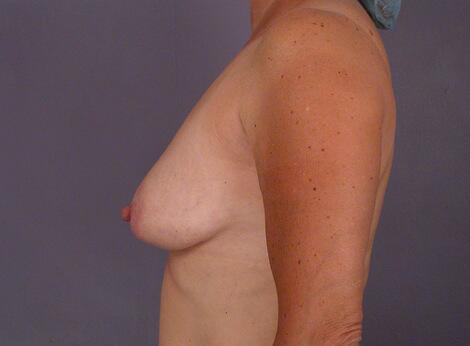 Liposuction Before & After Image