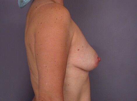 Liposuction Before & After Image