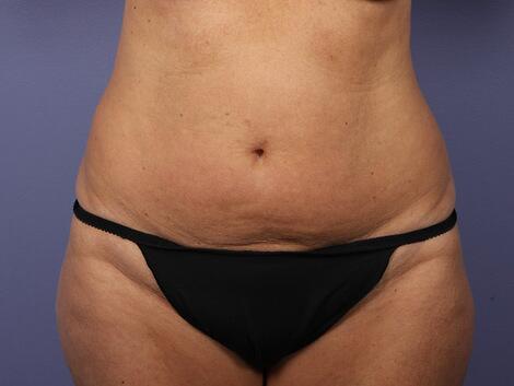 Liposuction Before & After Image