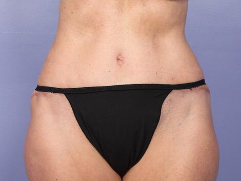 Liposuction Before & After Image