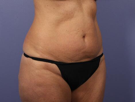 Liposuction Before & After Image