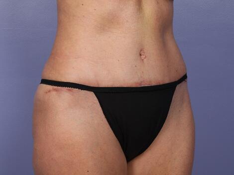 Liposuction Before & After Image