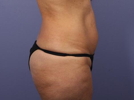 Liposuction Before & After Image