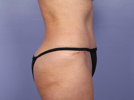 Liposuction Before & After Image