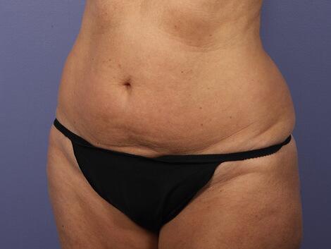 Liposuction Before & After Image